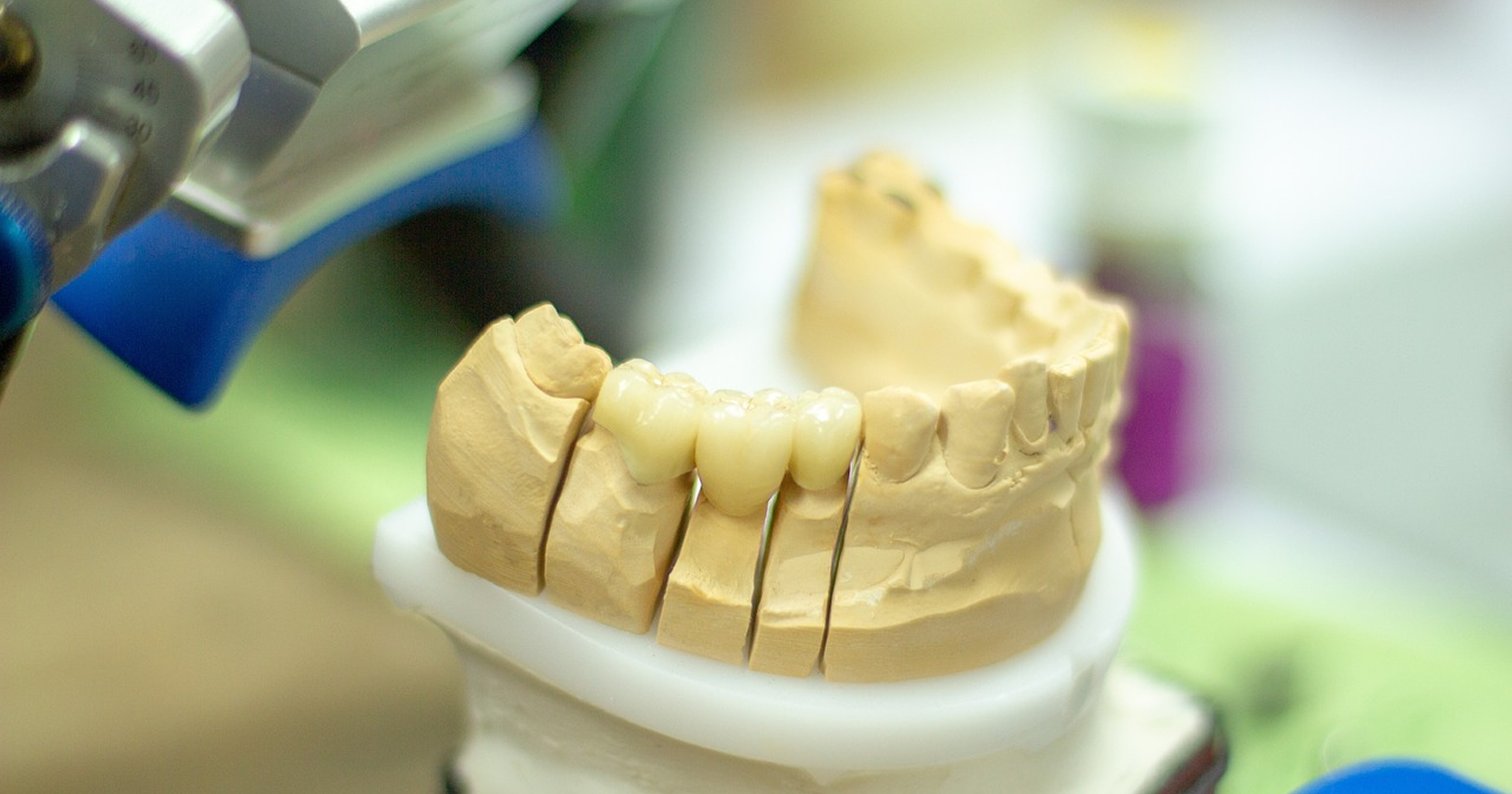 インプラントとブリッジの違いとは？どちらが最適？